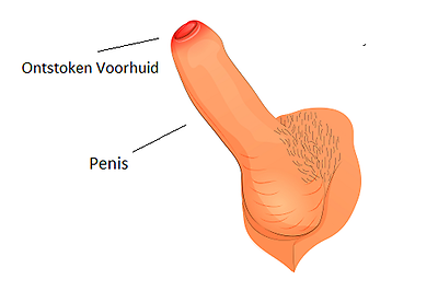 Ontstoken voorhuid penis