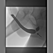 Röntgenfoto van de plasbuis