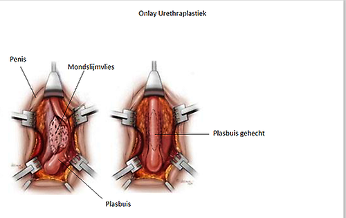 Onlay urethraplastiek